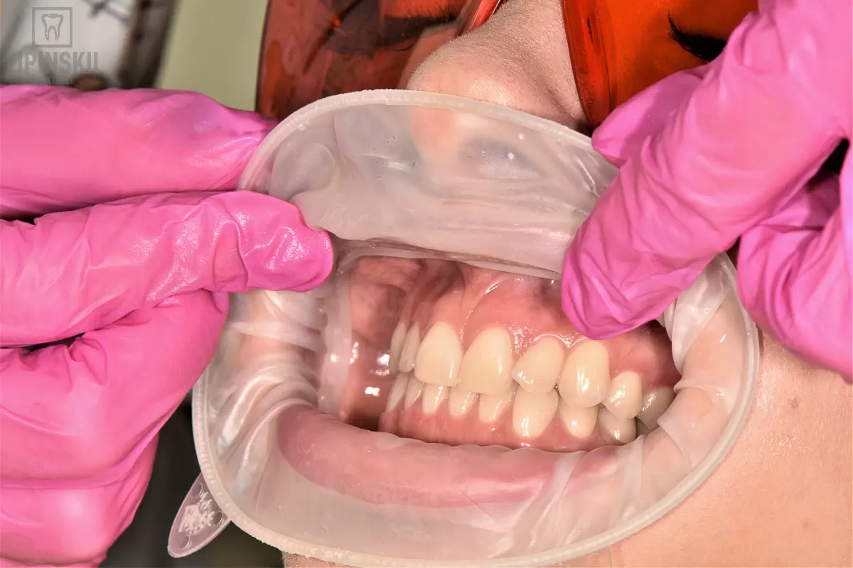 What to do before teeth whitening