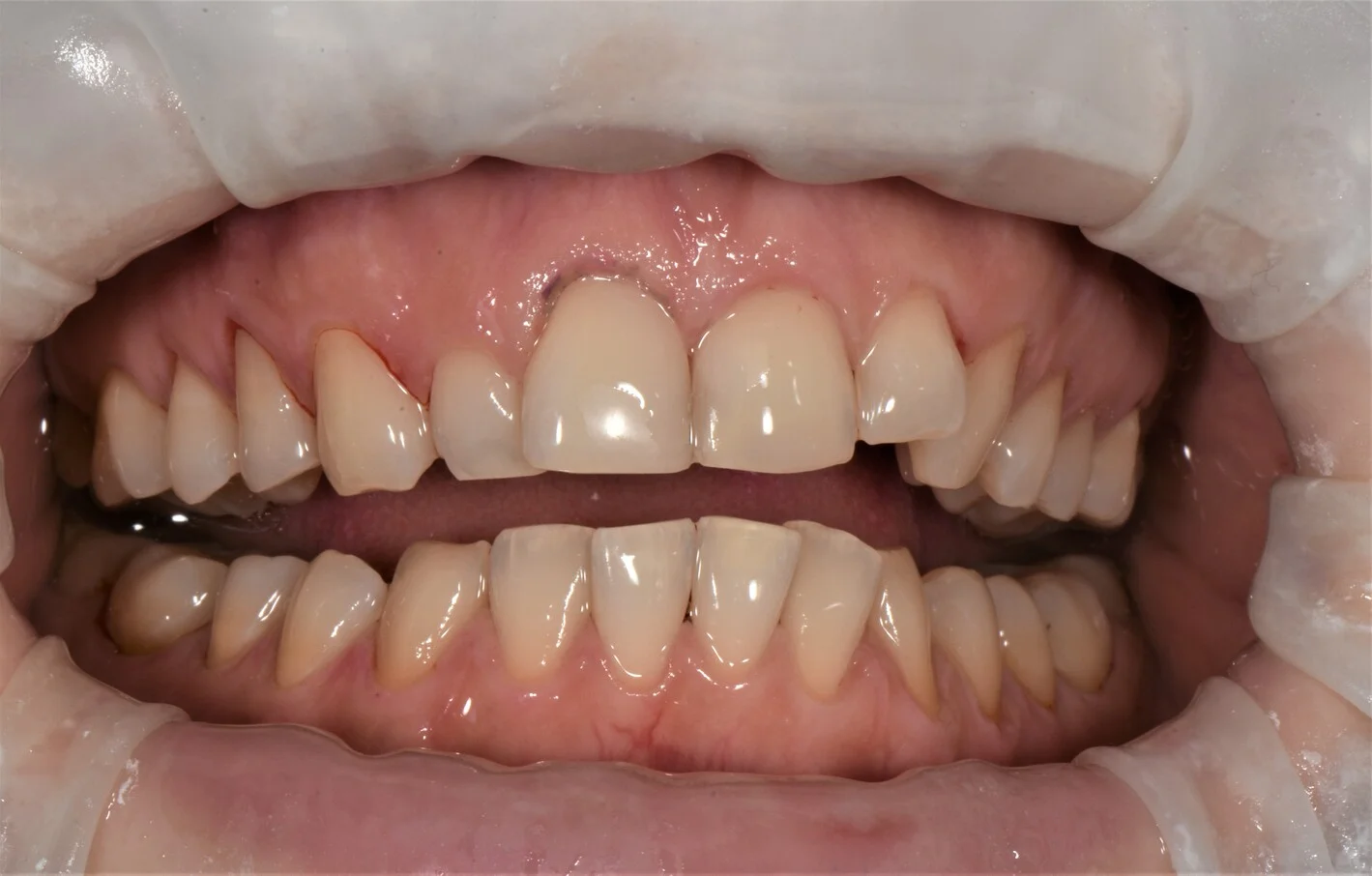 Canker sore treatment