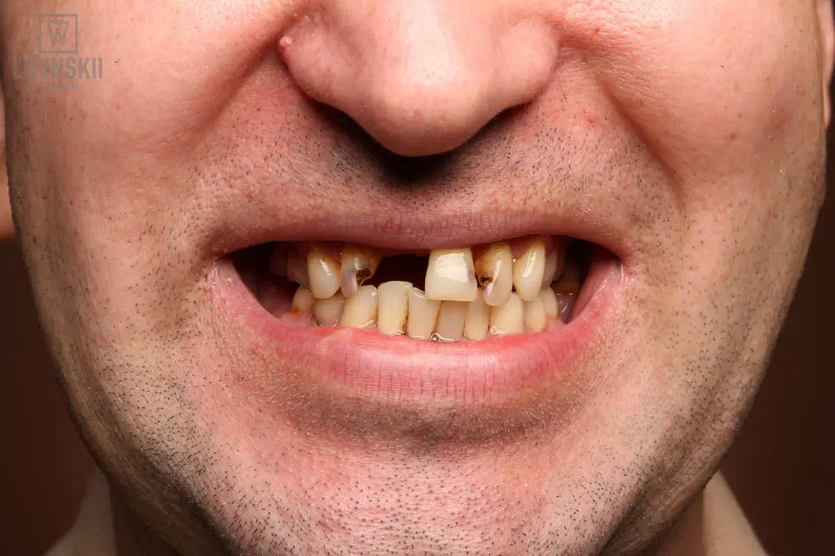 Are there any contraindications to treatment with a braces system?