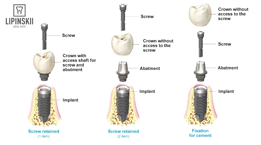 Turn key implantation