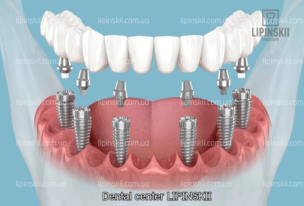 All-on-6 implant supported restoration