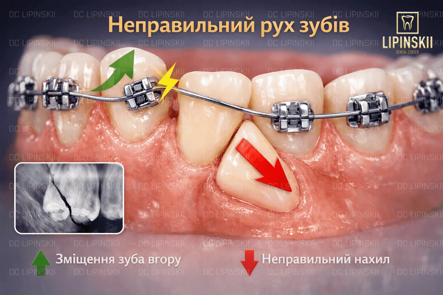 Неправильний рух зубів при брекетах