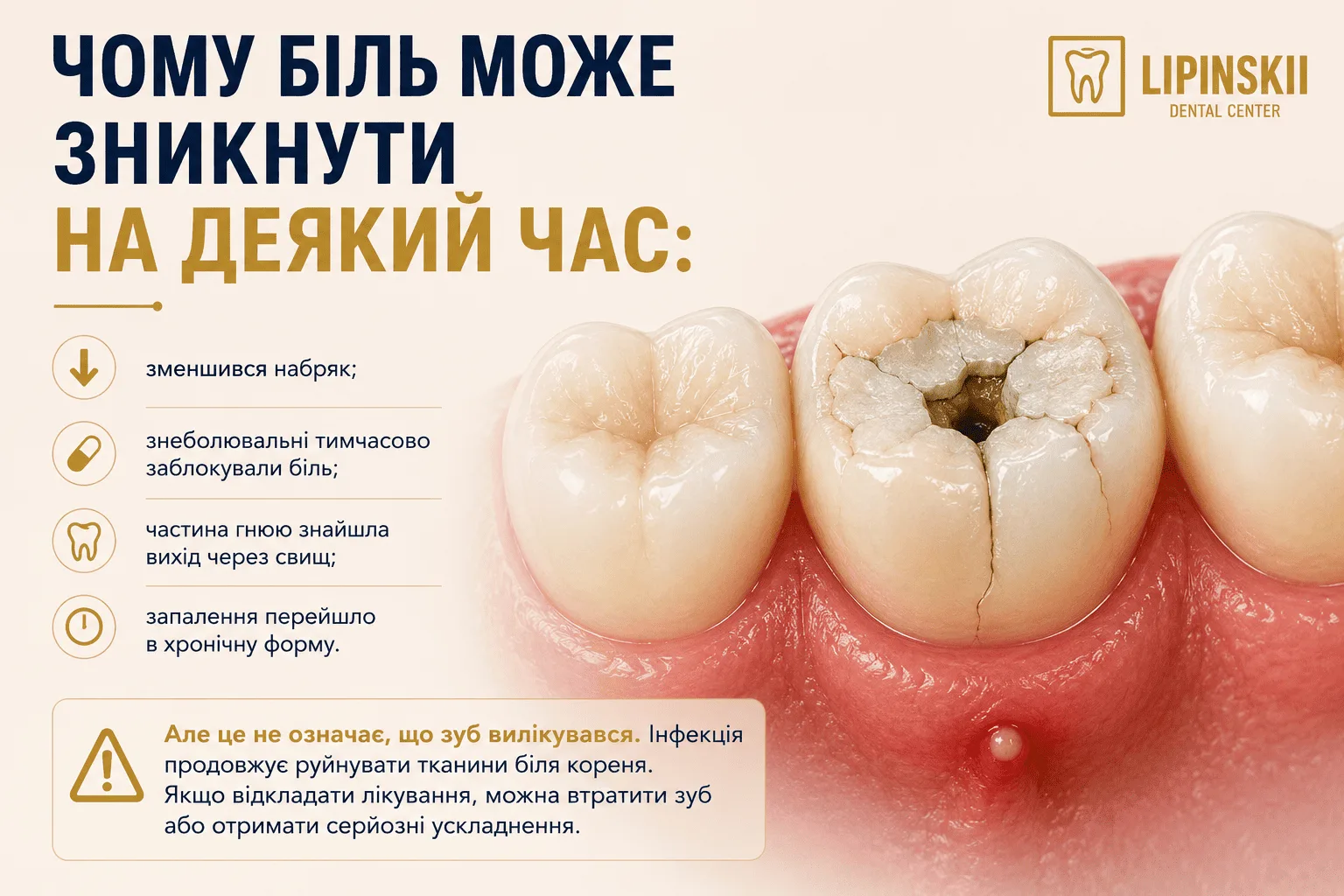 Чому біль при запаленні кореня зуба може тимчасово зникнути