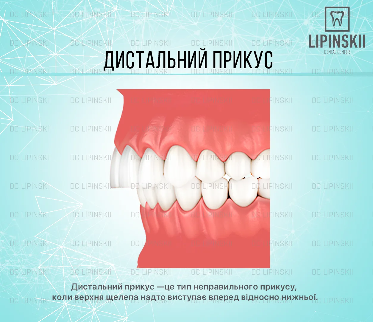 Дистальний прикус