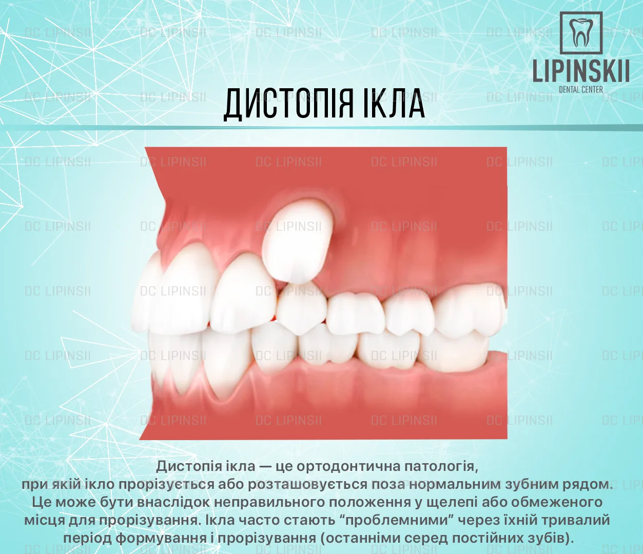 Дистопований зуб