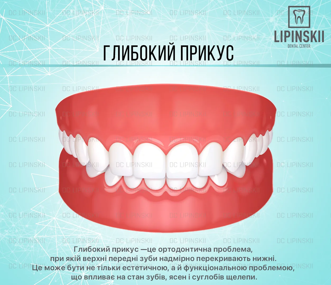 Глибокий прикус