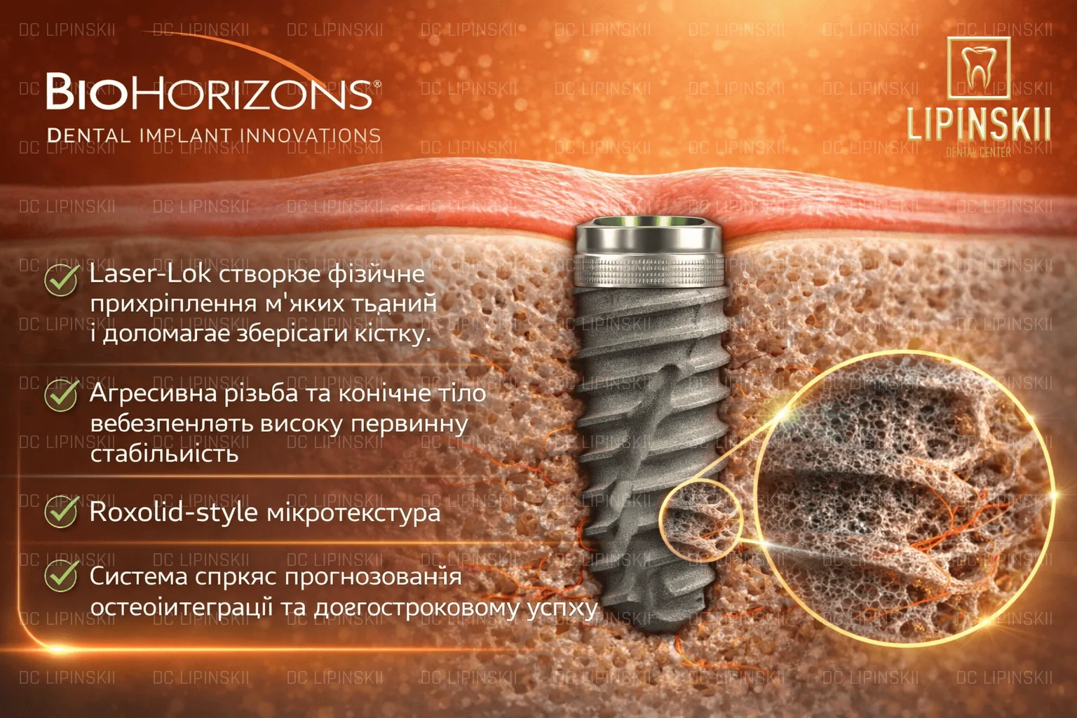 Імпланти BioHorizons