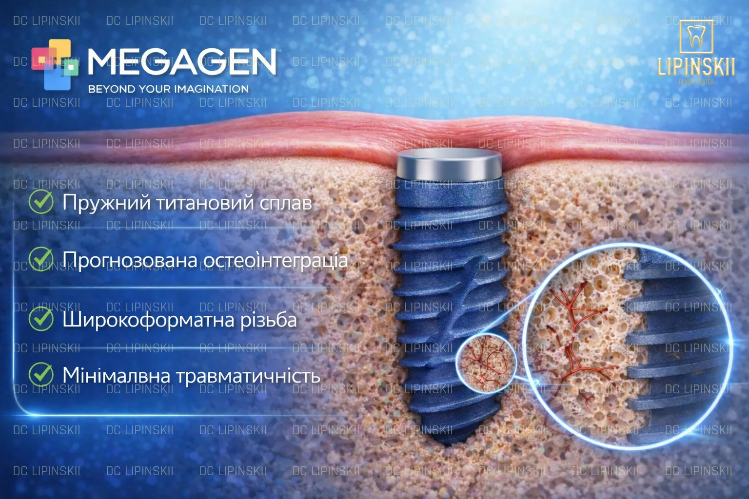 Імпланти MegaGen