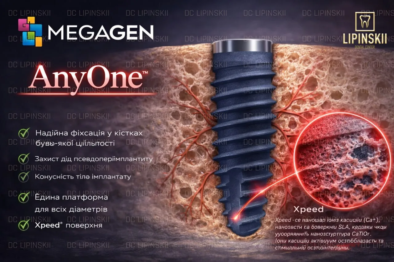 Імплант MegaGen AnyOne для універсальних клінічних випадків і оптимальної стабільності