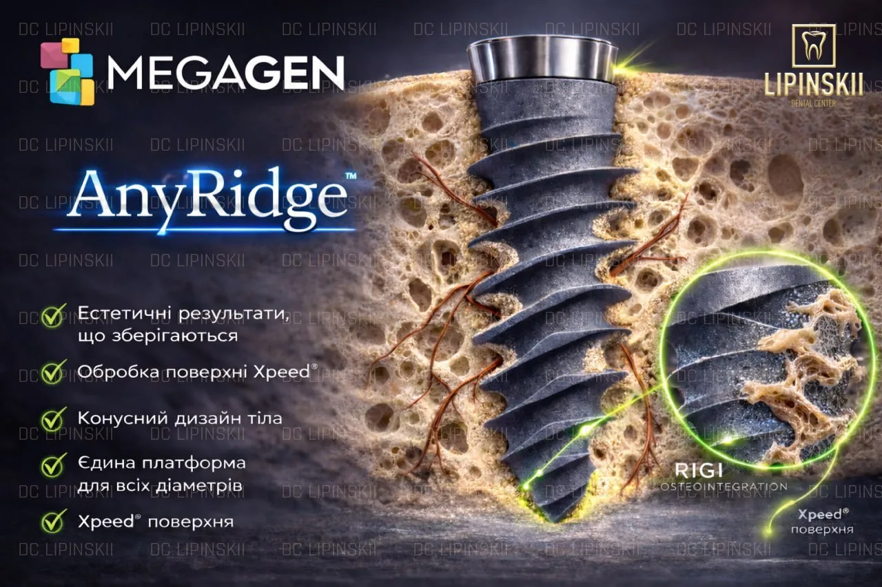 Імплант MegaGen AnyRidge з агресивною різьбою для високої стабільності і приживлення