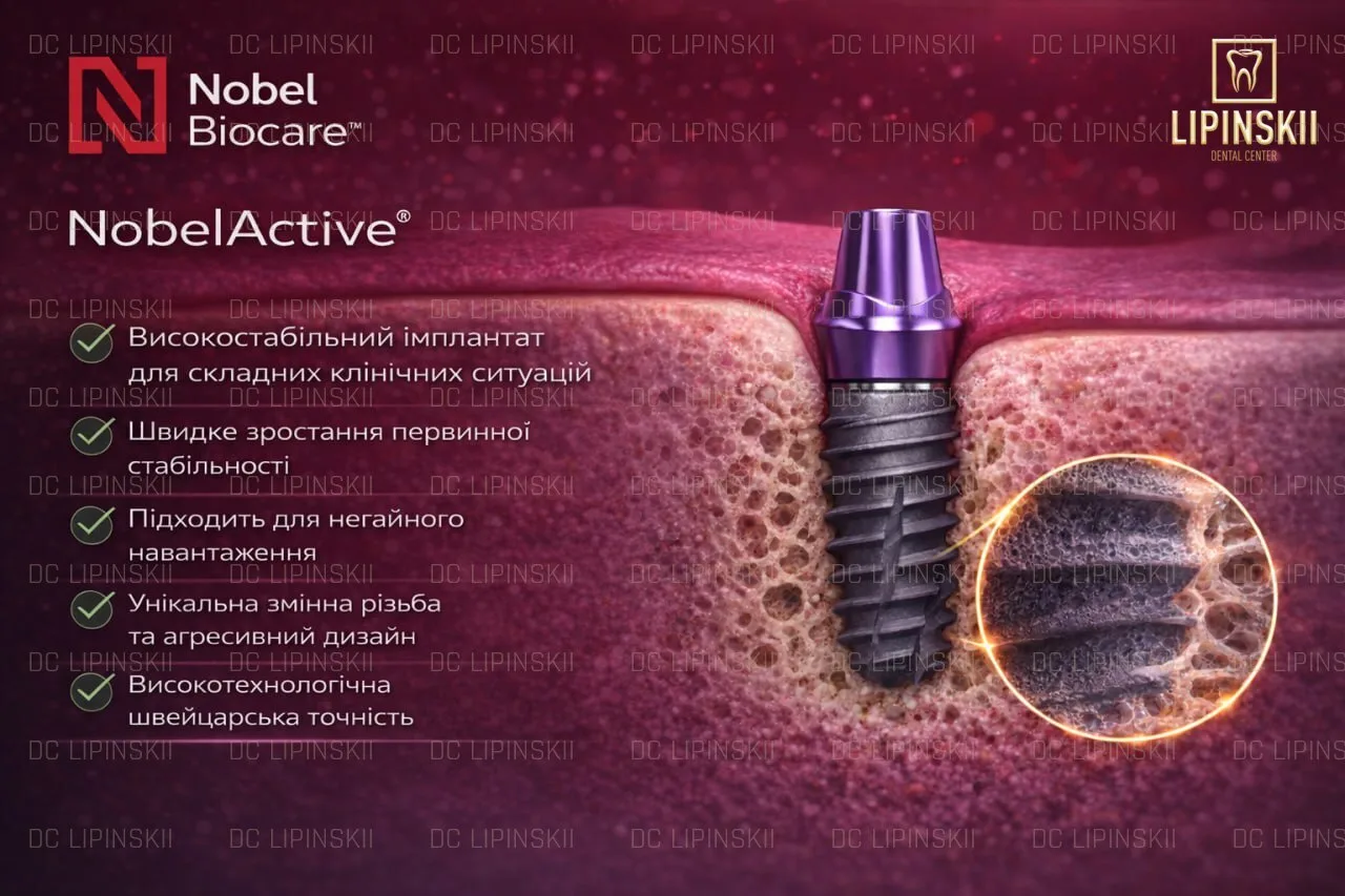 Імплант Nobel Active для стоматологічної імплантації з високою первинною стабільністю