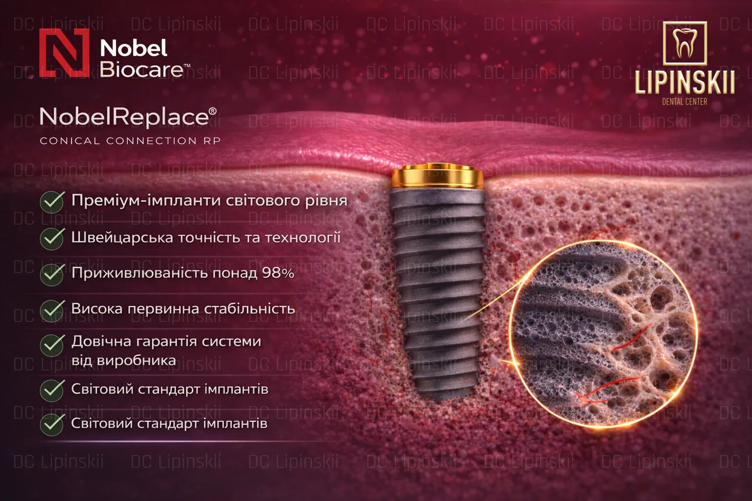 Импланты Nobel biocare (Нобель)