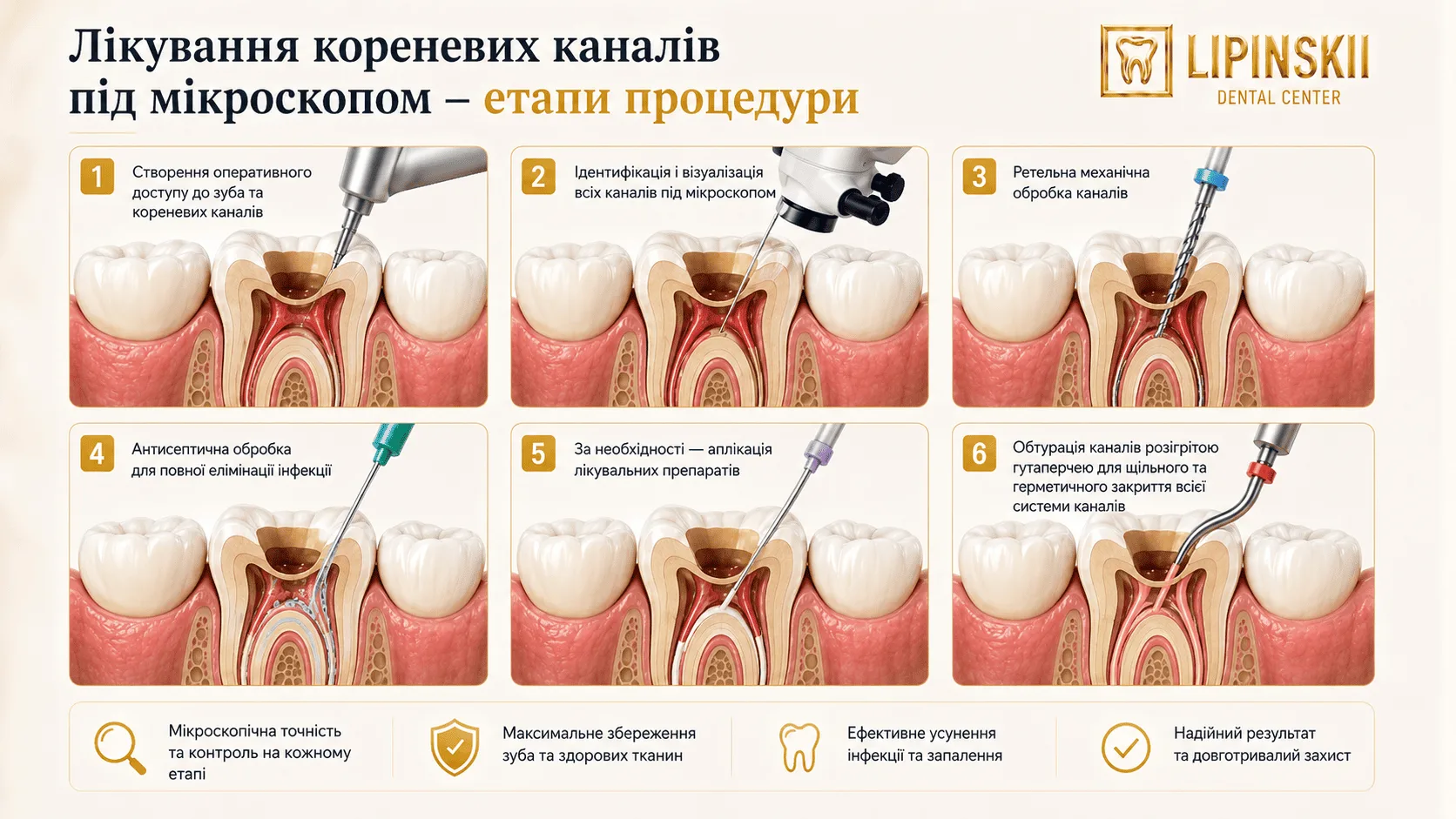 Лікування кореневих каналів під мікроскопом при запаленні кореня зуба