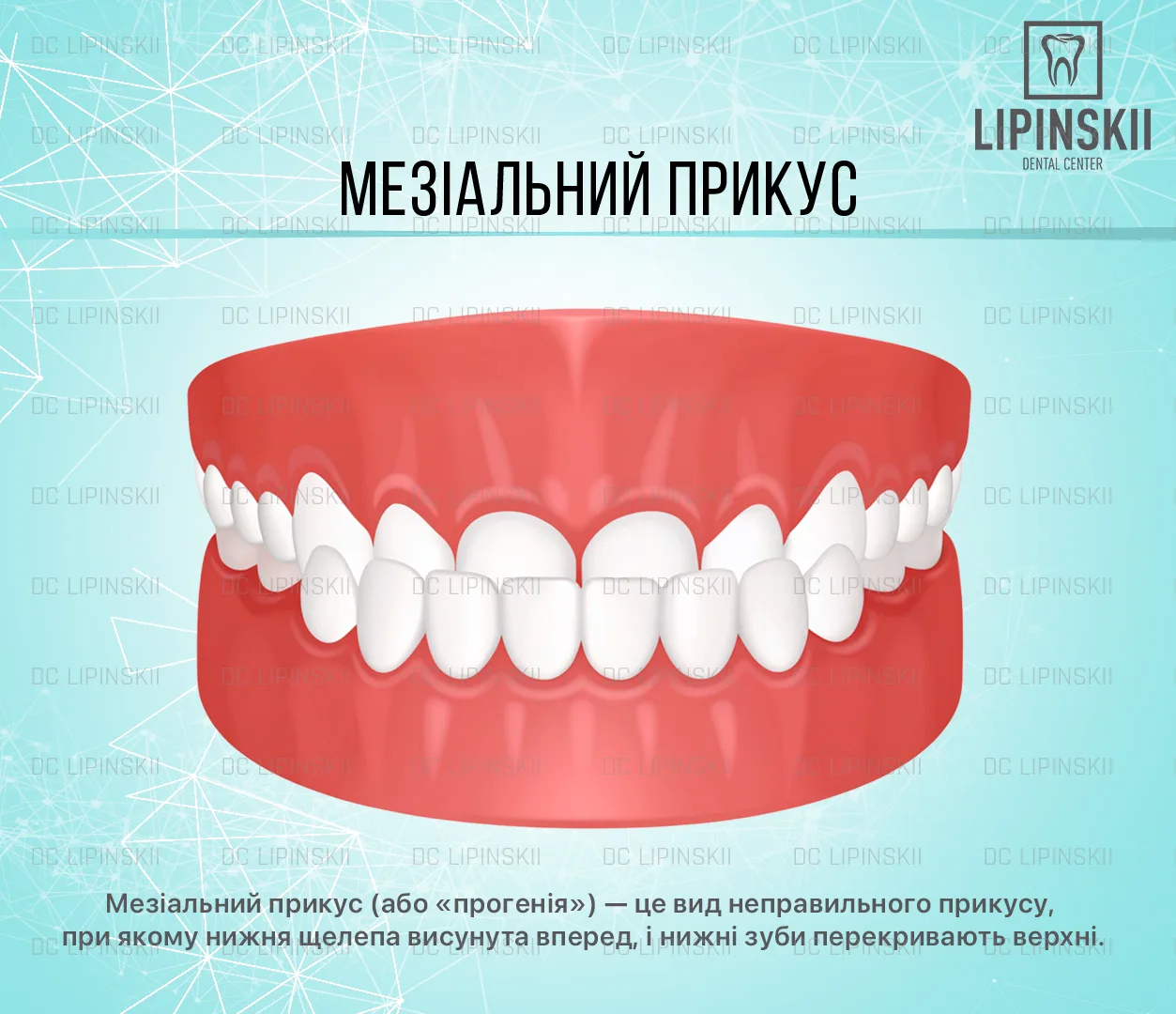 Мезіальний прикус