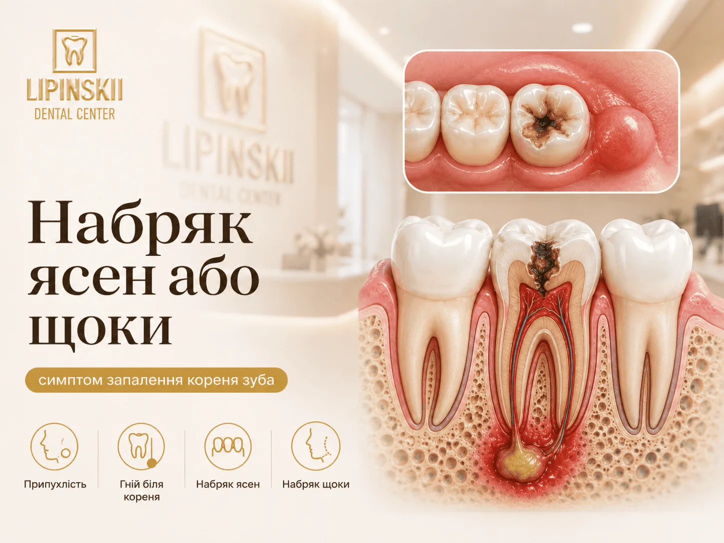 Набряк ясен або щоки при запаленні кореня зуба