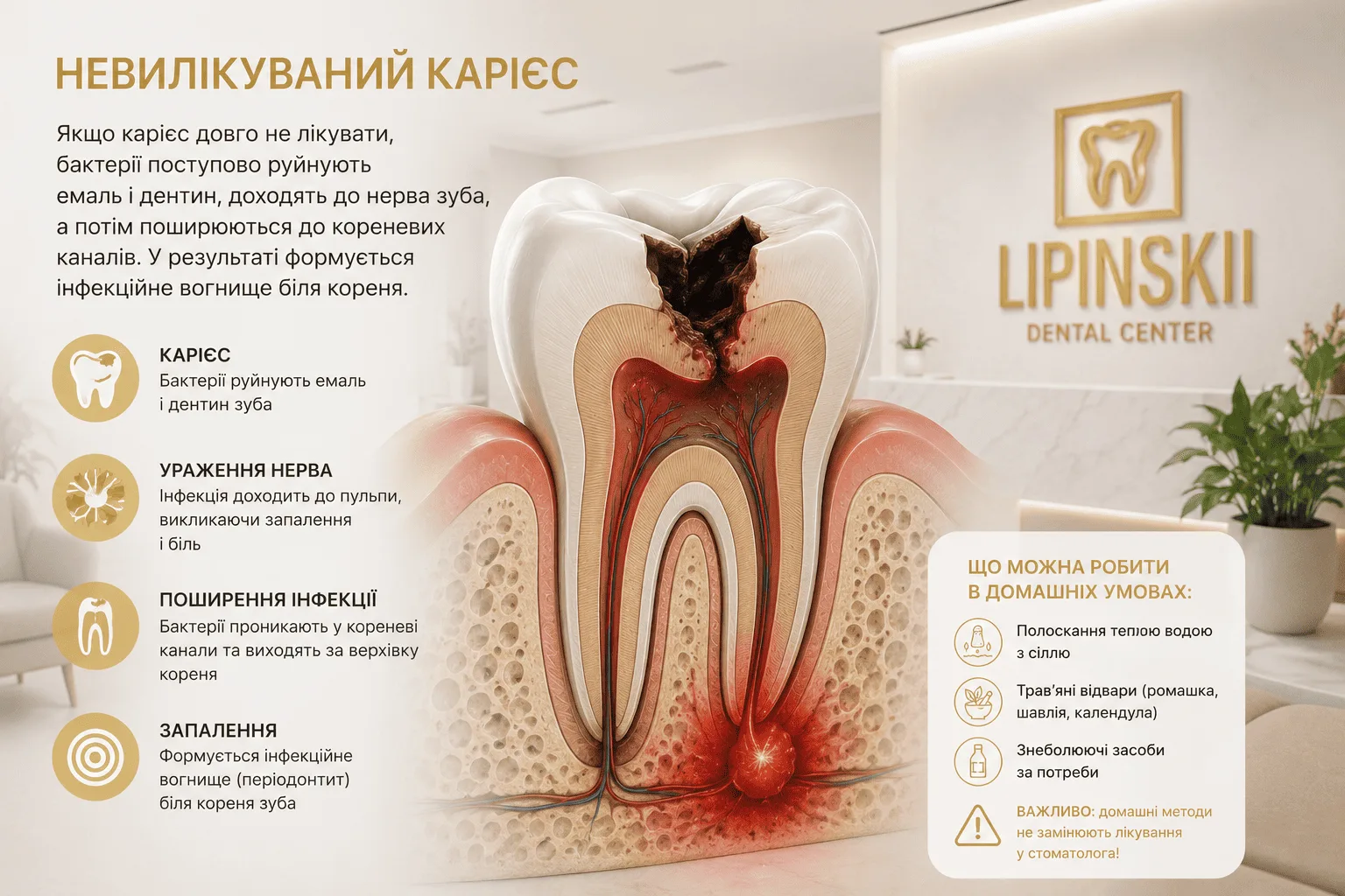 Невилікуваний карієс як причина запалення кореня зуба