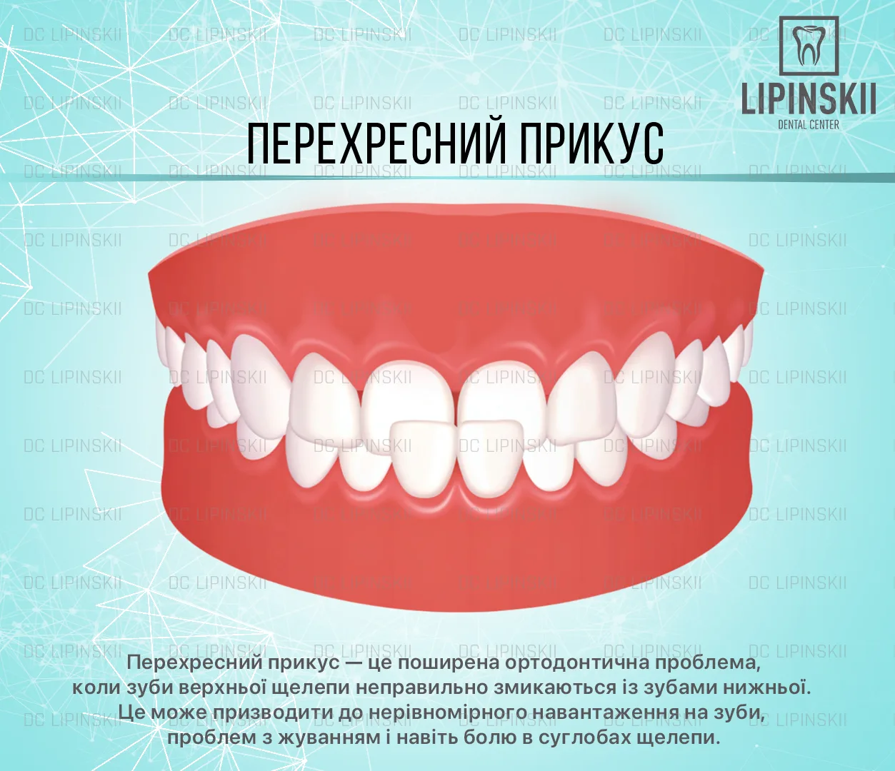 Перехресний прикус – аномалія змикання верхніх і нижніх зубів
