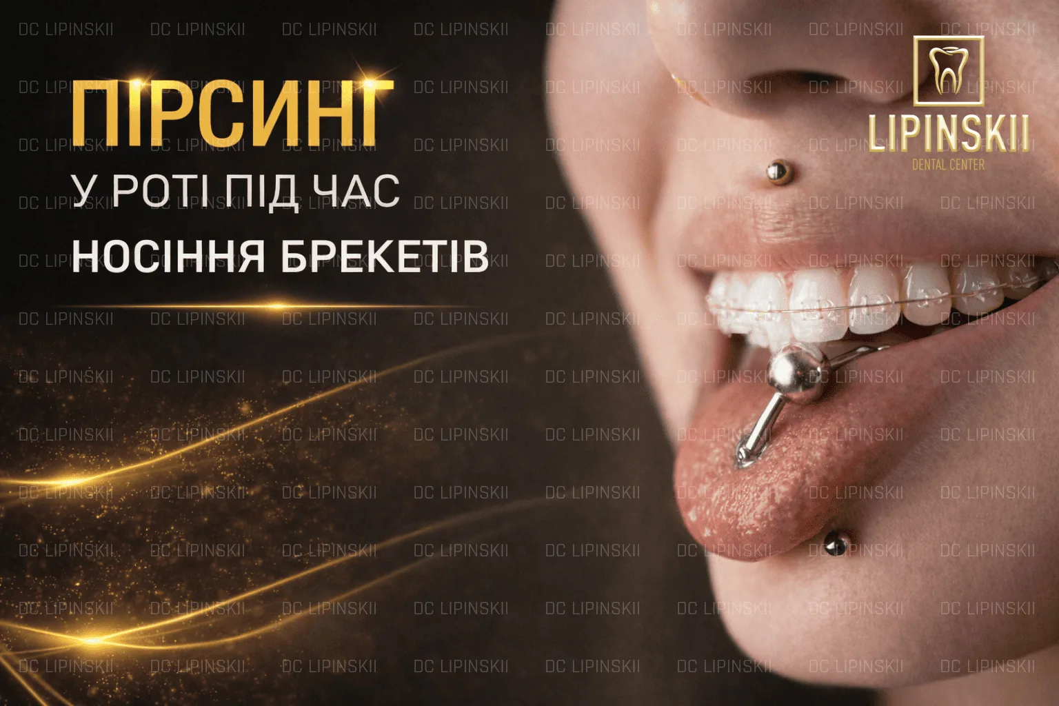 Пірсинг у роті під час носіння брекетів