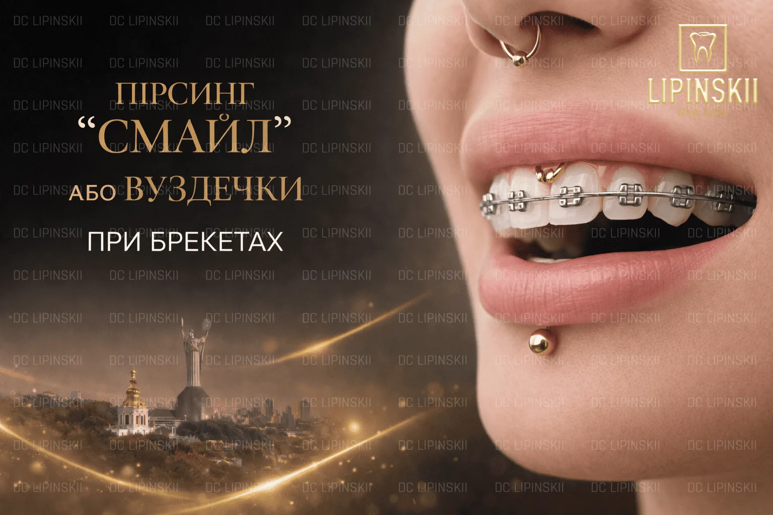 Пірсинг смайл або вуздечки при брекетах