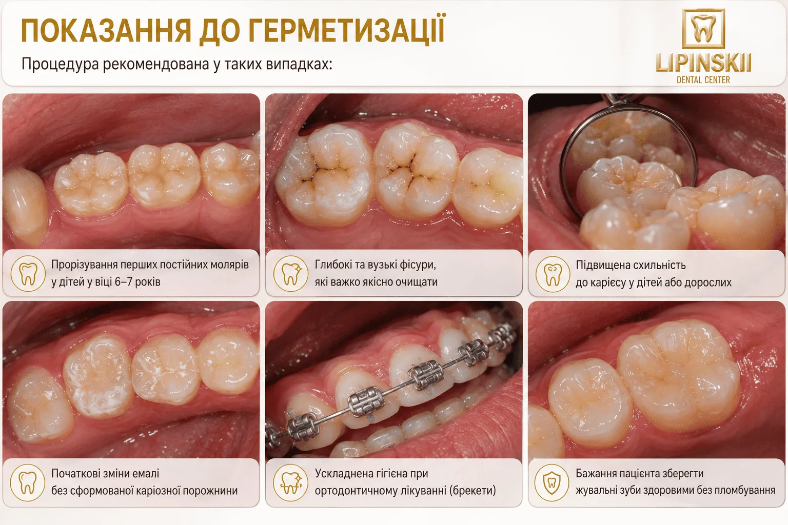 Показання до герметизації фісур у дітей та дорослих