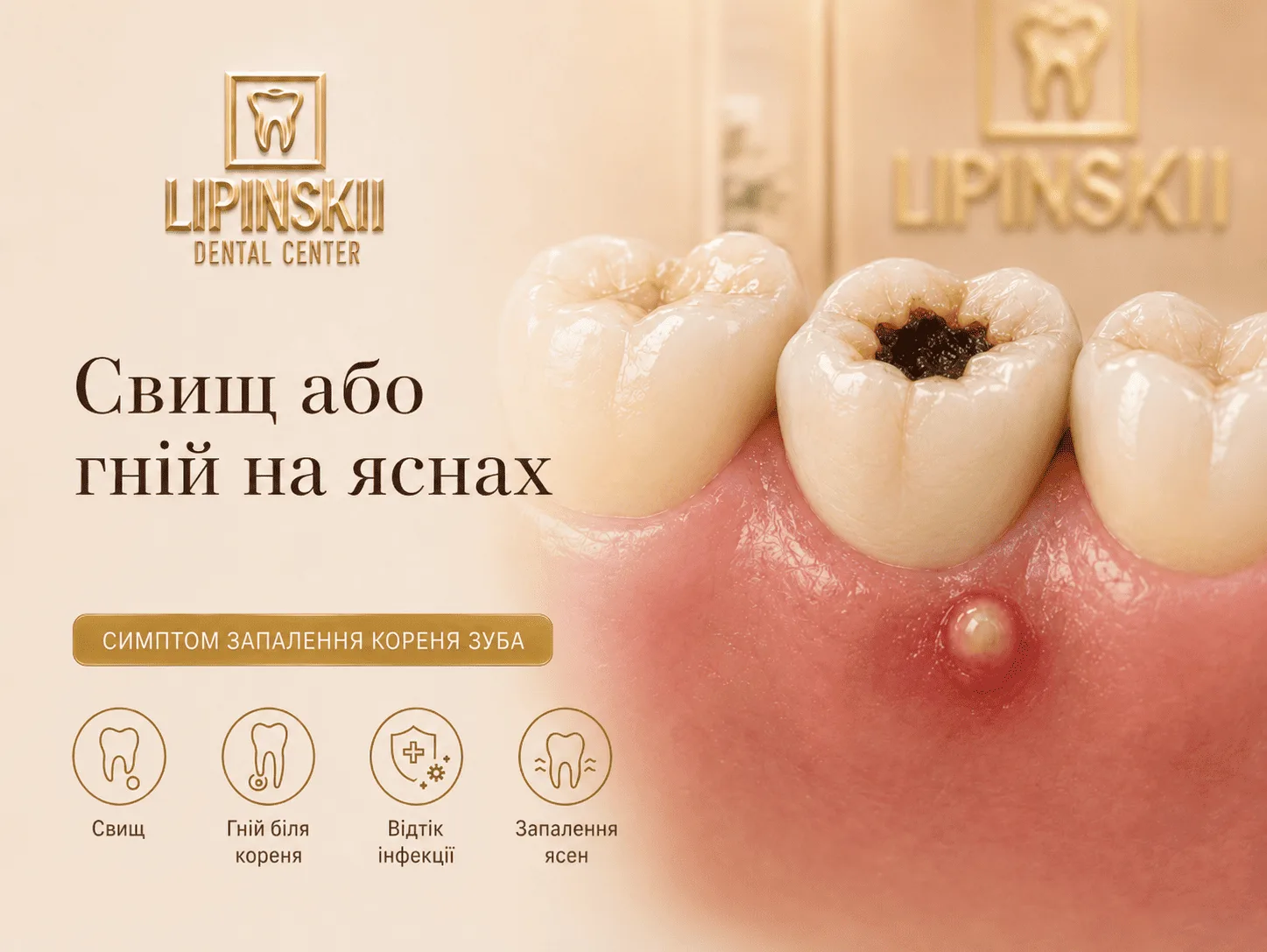 Свищ або гній на яснах як ознака запалення кореня зуба