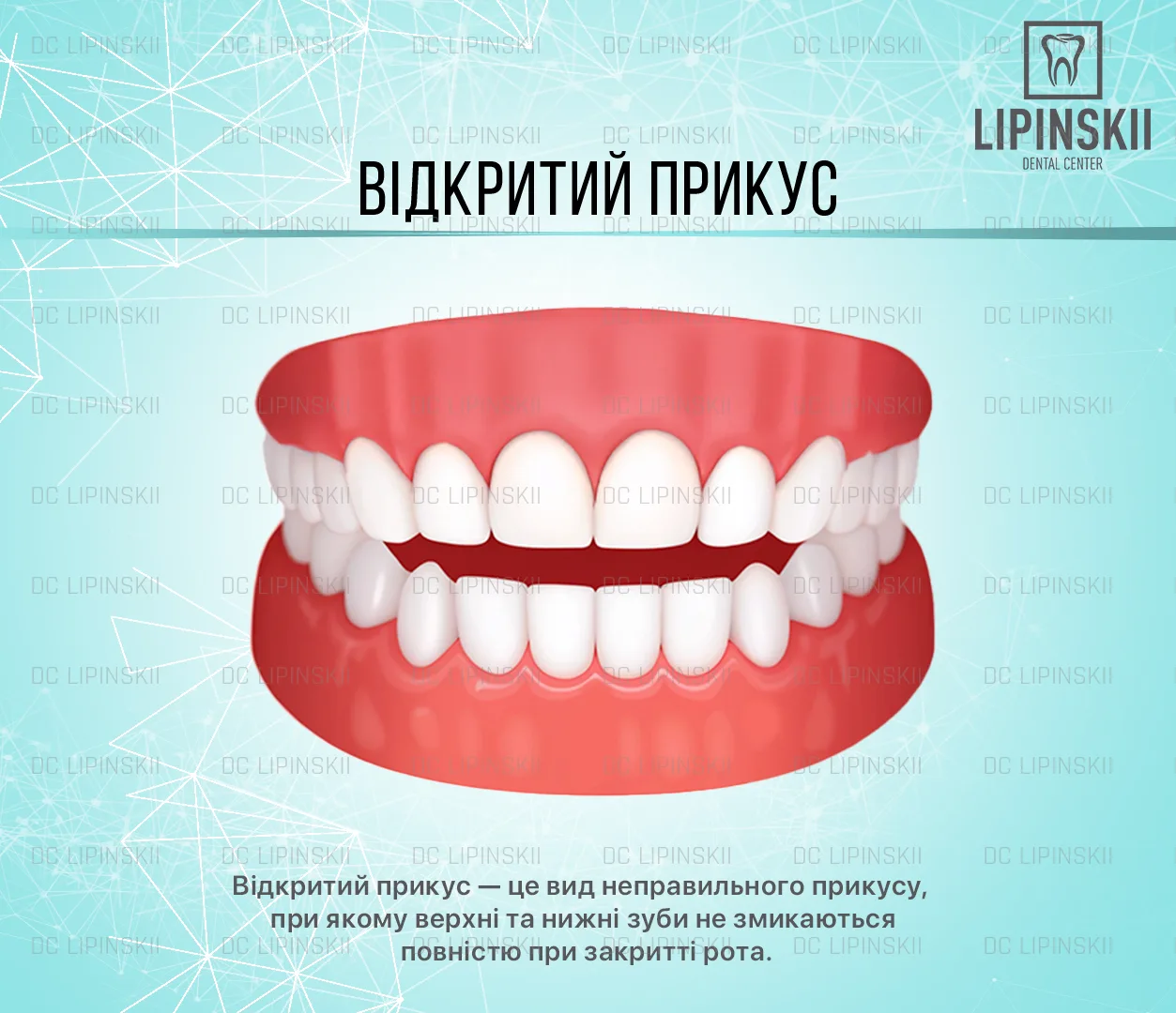 Открытый прикус