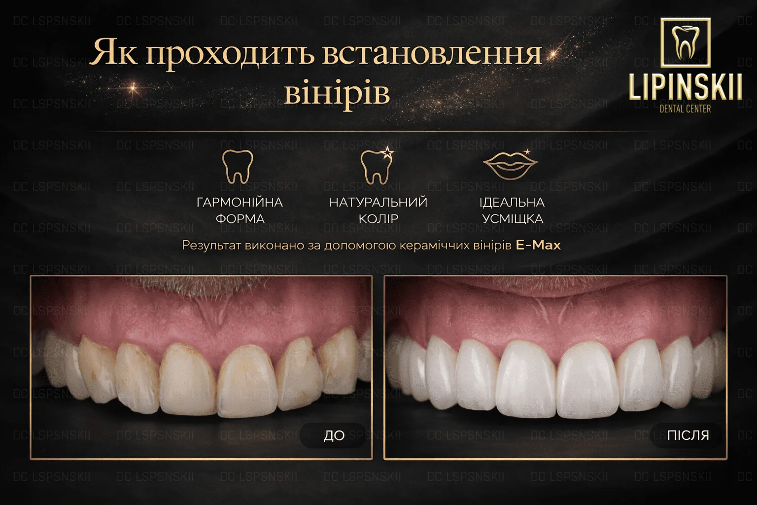 Як проходить установка вінірів – етапи лікування від консультації до фіксації